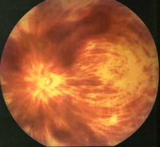 Тромбоз Центральной Вены Сетчатки Глаза
