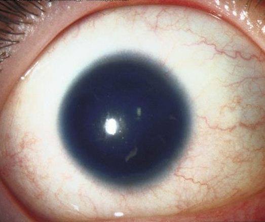 Аномалии развития глаза: аниридия