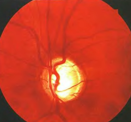 Глаукомная экскавация диска зрительного нерва