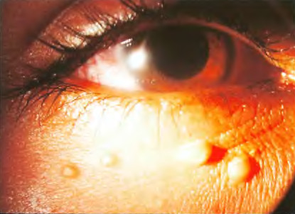 Контагиозный моллюск - опухла нижняя века глаза
